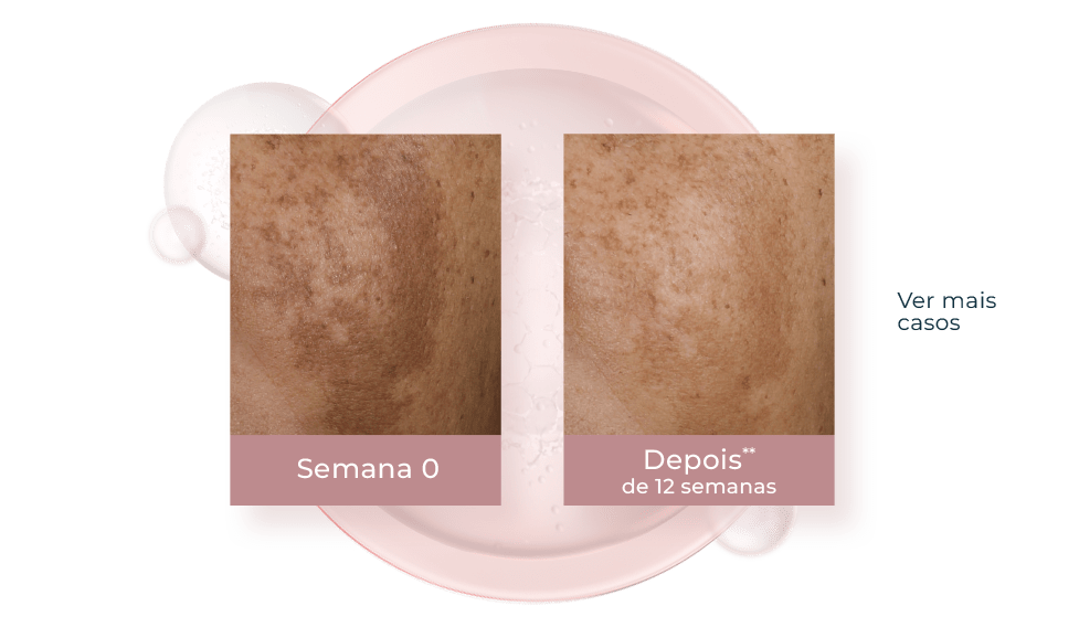 Thiamidol: O Ingrediente Anti-Manchas Mais Efetivo | Eucerin®
